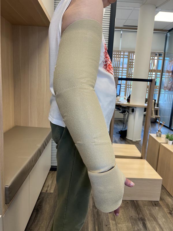 traitement du lymphoedeme suite à un cancer du sein